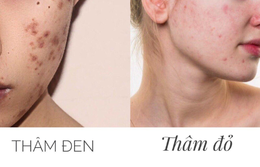 Cách trị thâm mụn hiệu quả tại nhà - thử ngay 